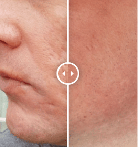 Facial Resurfacing